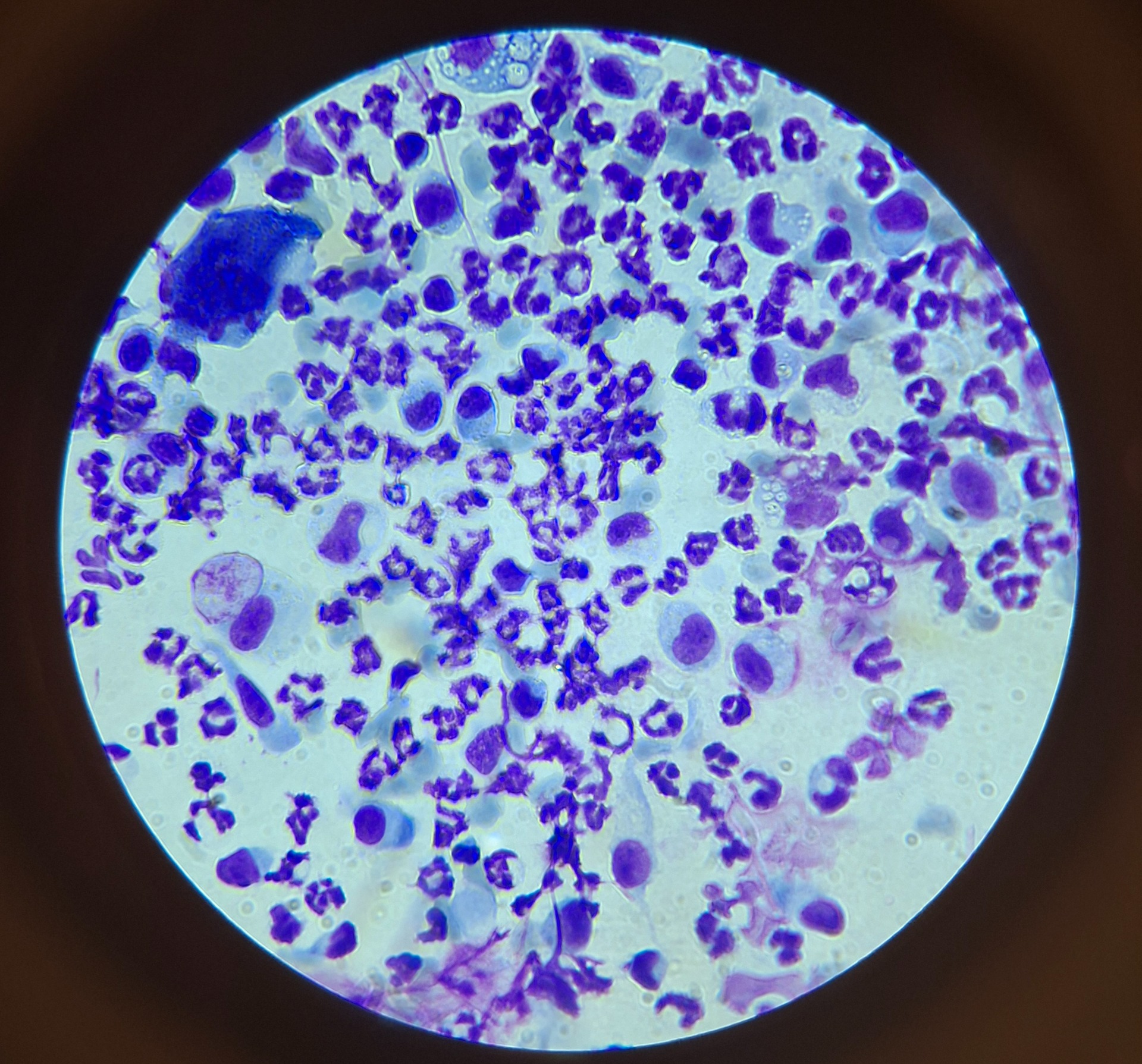 A citológiai mintában gyulladásos sejtek láthatók, kórokozók nincsenek